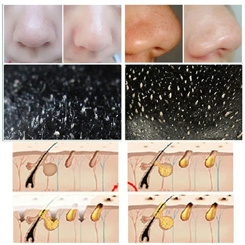 10pcs Blackhead แถบจมูกทําความ - Cleanser Face บทวิจารณ์และราคา